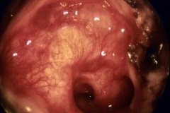 Mastoid cavity, R ear, wet, mucosal lining, no TM, exposed ET and RW