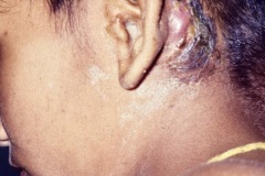 Mastoid, chronic abscess and fistula, CSOM, cholesteatoma, young boy, L ear