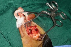 Opening ear for postaural chronic fistula and cholesteatoma