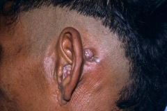 Postaural fistula and aural polyps