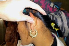 Postaural fistula from CSOM