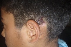 Postaural fistula with dried discharge, chronic, CSOM