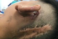Postaural fistula, untreated cholesteatoma, previous posterior fossa brain abscess, left ear, 8y boy