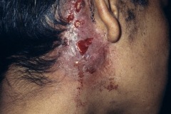 Postaural fistulae, CSOM (?TB), R ear