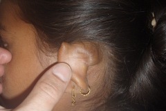 Postauricular Dermoid Cyst, young girl