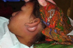 Young girl with postaural abscess