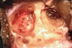 Cortical mastoidectomy, R ear, cellular mastoid