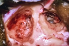 Cortical mastoidectomy, R ear