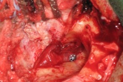 MRM with titanium TORP in oval window niche, ready for drum and mastoid cavity reconstruction
