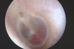 Glomus-tympanicum