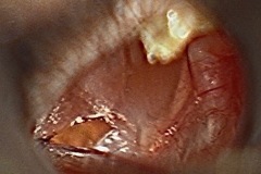 Myringotomy,left ear, glue ear