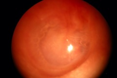 Secretory Otitis Media, bubbles in middle ear