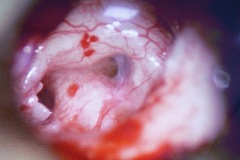 Round window, active perilymph leak after blunt force trauma to left ear, 12 y boy