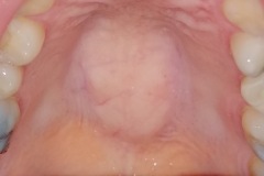 Torus Palatinus