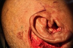 Skin adenoid cystic carcinoma of canal, concha and postaural subcutaneous tissues (1), excision and rotation flap, 84y male