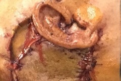 Skin adenoid cystic carcinoma of canal, concha and postaural subcutaneous tissues (2), excision and rotation flap, 84y male
