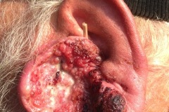 Squamous carcinoma involving pinna
