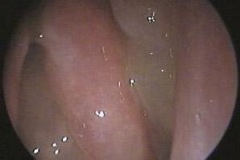 nasal polyps