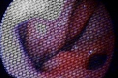 R nasal cavity, small septal perforatio