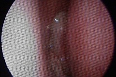 Nasal polyps