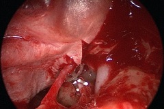 Exposed horizontal facial nerve, found during attico-antrostomy and tympanoplasty, L ear, with 'clip' kurz PORP on stapes, and TM graft in process