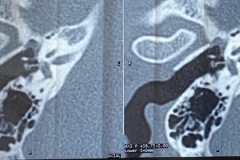 Failed stapedotomy, prostheis not connected to incus, subsequently underwent revision with replacement prosthesis and improved hearing