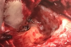 Mastoidectomy, MRM cavity, L ear, with 'hand made' titanium wire TORP, two prostheses, 0.25 and 0.5 mm wires