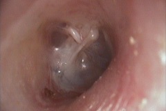 Partially extruded teflon stapes prosthesis, R ear,B