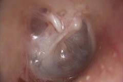 Partially extruded teflon stapes prosthesis, R ear,C