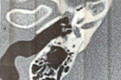 Stapes prosthesis dislocated from incus, failed stapedotomy, conductive hearing loss, subsequently revised, prosthesis replaced  and hearing improved