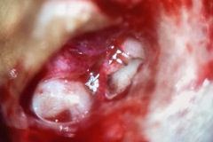 Titanium clip reconstruction of incudo-stapedial joint with eroded long process of incus