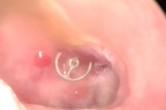 Titanium ossicular replacement prosthesis extrruding through drum, some small superficial granulations/myringitis on TM, R ear