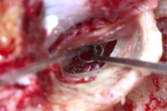 Total Ossicular Replacement Prosthesis, insertion L ear; Combined Approach Tympanoplasty; TORP being placed on stapes footplate in oval window niche and covered with temporalis fascia and cartilage