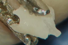 Incus prepared for malleus handle to stapes head interposition