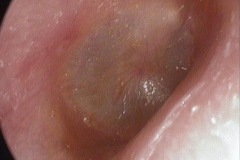 Chronic low grade otitis externa, red TM and canal skin, excessive self cleaning of itchy ear canal, R ear