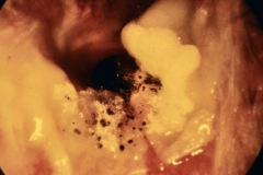 Otitis Externa, fungal debris in canal, white, with black aspergillus niger spores, L ear