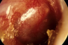 Acute Otitis Media, Bulging TM, pus in middle ear, inflammed drum, R ear