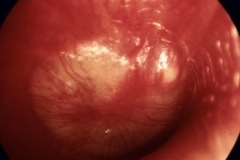 Acute Otitis Media, TM bulging, pus in ME, inflammed TM, R ear