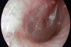 Otitis media, red malleus handle and upper TM, dull tm, middle ear effusion