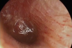 Resolving acute otitis media, red drum