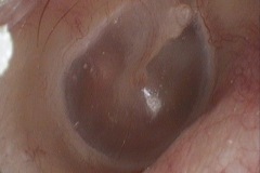 Flamingo flush, active otosclerosis focus, seen through TM, R ear, F 23 years
