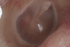 Otosclerosis bilateral, Flamingo flush, Schwartz sign, redness od actice otosclerosis focus seen around oval window visible hrough TM, R ear