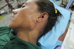 Parotid tumour 3