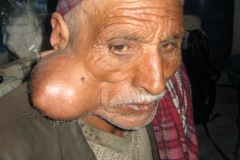 Parotid tumour, R side, male 2