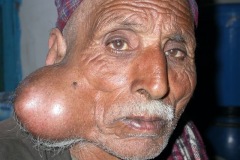 Parotid tumour, elderly male