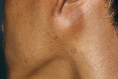 Parotid tumour, lump below L ear lobe, young man