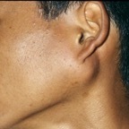 Parotid tumour, lump below L ear, young man