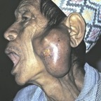 Parotid tumour, male