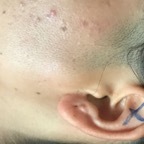 Parotid tumour, pleomorphic adenoma, young female