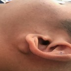 Parotid tumour, pleomorphic adenoma, young male
